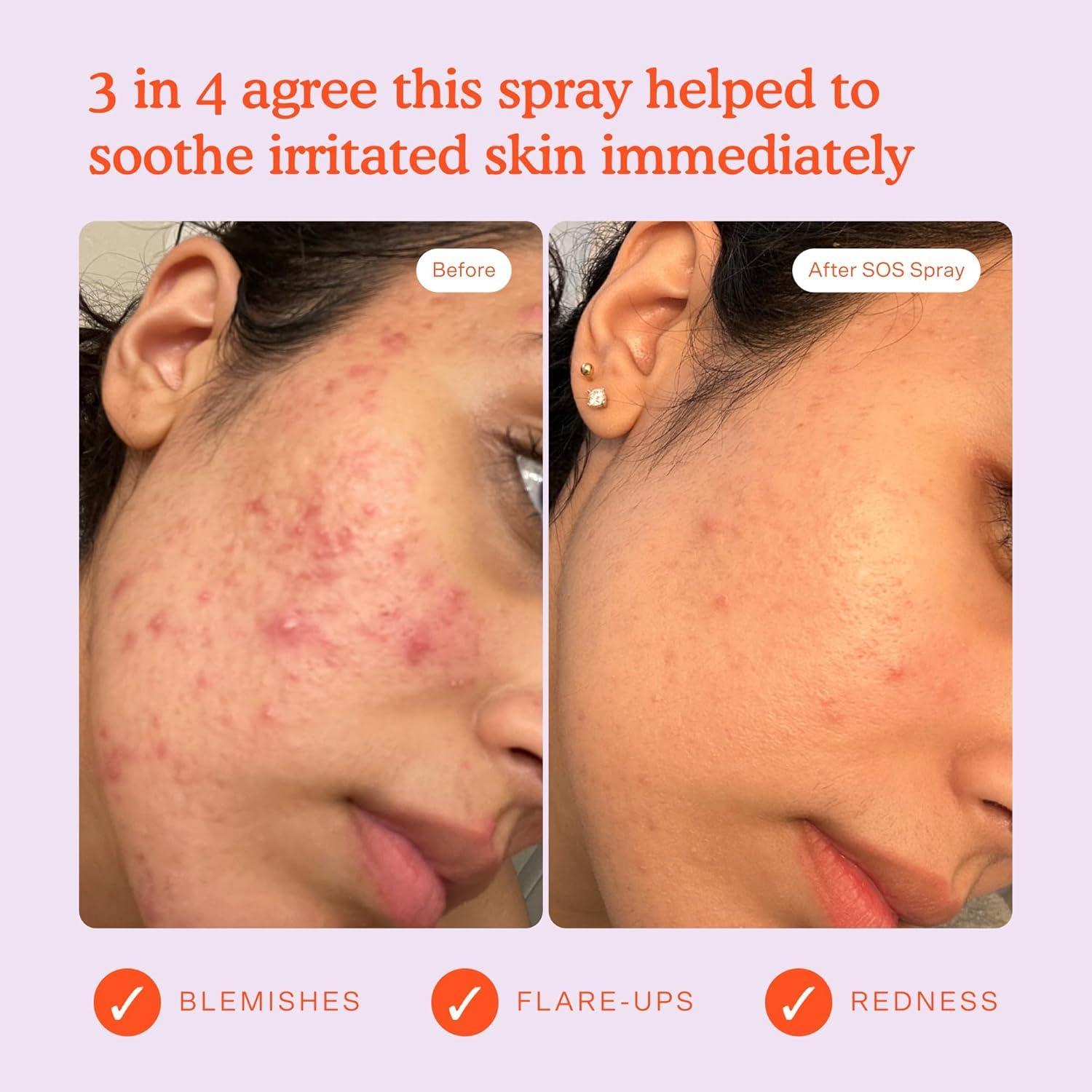 imageTower 28 SOS Daily Rescue Facial Spray Hypochlorous Acid Spray to Help Reduce Redness Calm Irritation Alleviate FlareUps Purifying Travel Size Face Toner Everyday Skin Care Essential 1 oz5 Fluid Oz Pack of 2